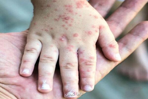 زنگ خطر مبتلا شدن به سرخک در هرمزگان موج ابتلاها در کودکان زیر ۶ ماه است