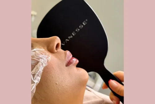 تاثیر فیلر لب بر زیبایی صورت